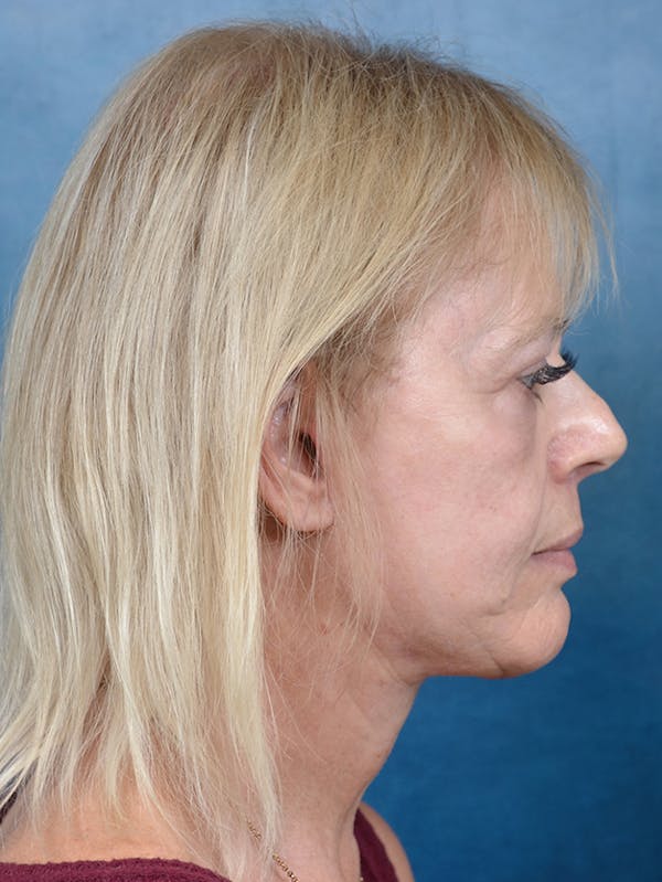 Brow Lift Before & After Gallery - Patient 141137888 - Image 10