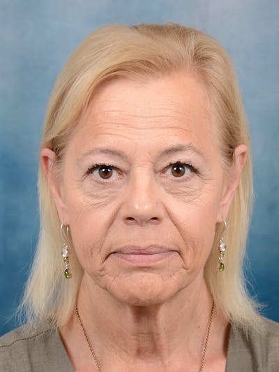 Brow Lift Before & After Gallery - Patient 141137888 - Image 1