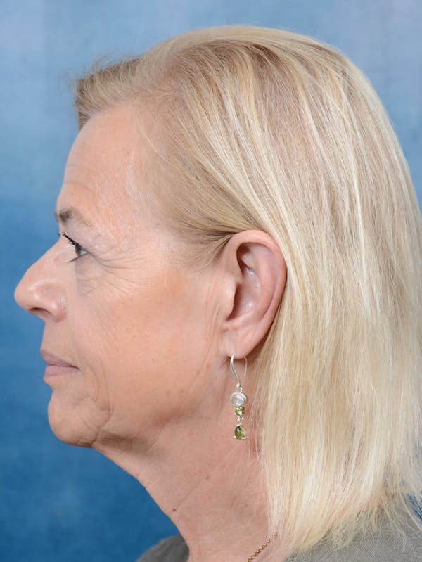 Brow Lift Before & After Gallery - Patient 141137888 - Image 3