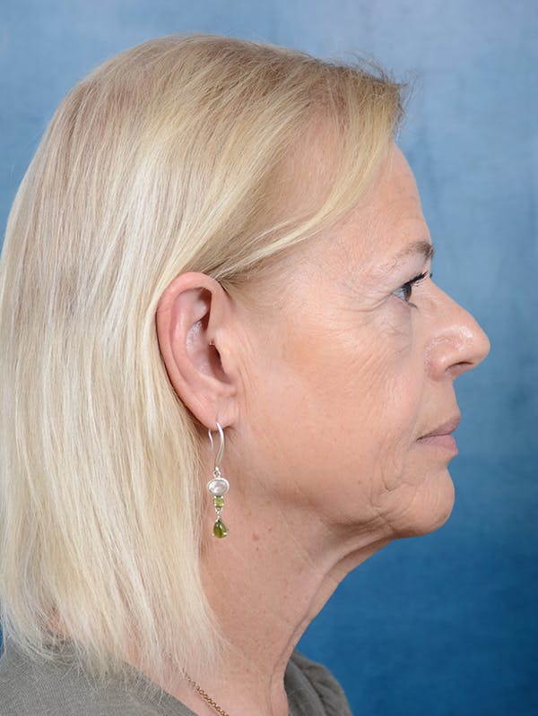 Laser Skin Resurfacing Before & After Gallery - Patient 141137965 - Image 9