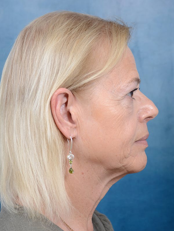 Deep Plane Facelift Before & After Gallery - Patient 141137879 - Image 7