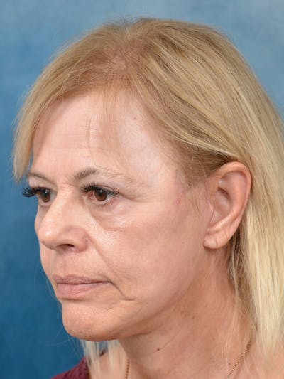 Laser Skin Resurfacing Before & After Gallery - Patient 141137965 - Image 4
