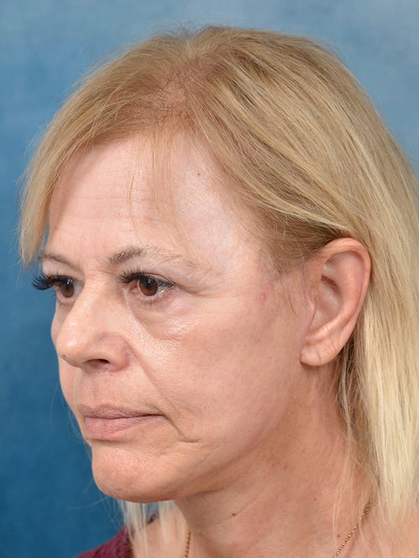 Brow Lift Before & After Gallery - Patient 141137888 - Image 6
