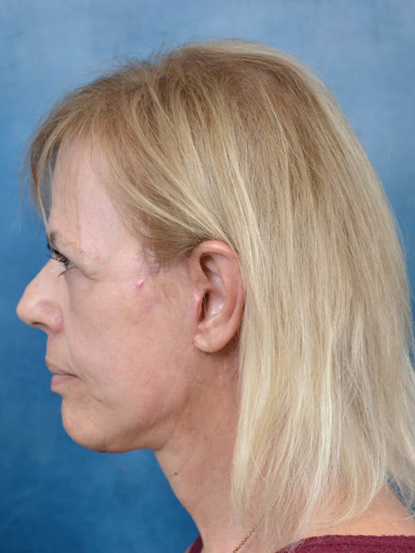 Deep Plane Facelift Before & After Gallery - Patient 141137879 - Image 6