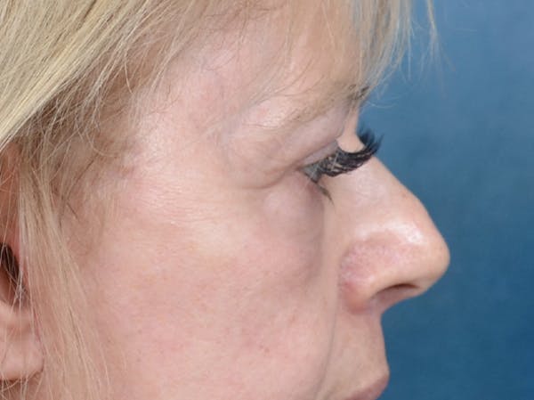 Eyelid Lift Gallery - Patient 141137956 - Image 8