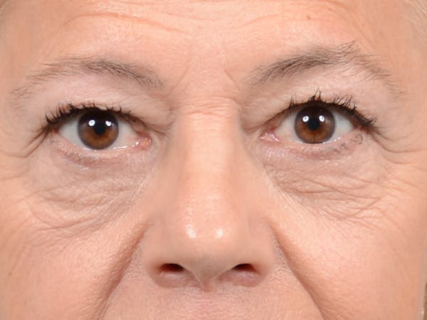Eyelid Lift Before & After Gallery - Patient 141137956 - Image 1