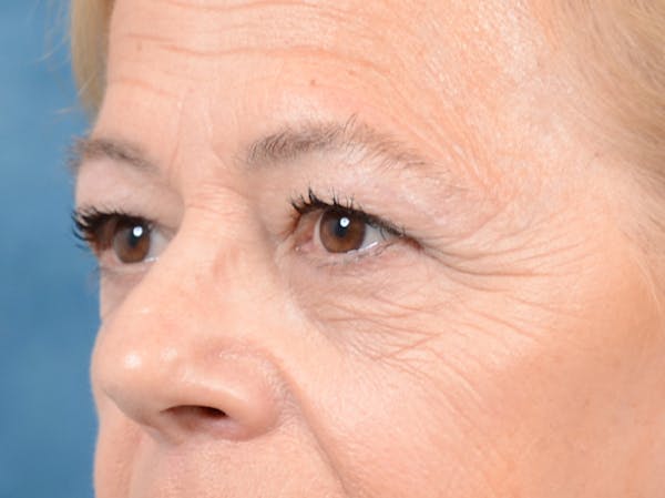 Eyelid Lift Before & After Gallery - Patient 141137956 - Image 3