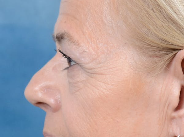 Eyelid Lift Gallery - Patient 141137956 - Image 5
