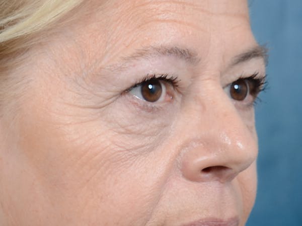 Eyelid Lift Before & After Gallery - Patient 141137956 - Image 9