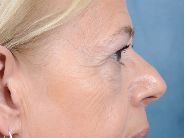 Eyelid Lift Before & After Gallery - Patient 141137956 - Image 7
