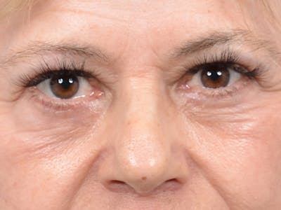 Eyelid Lift Before & After Gallery - Patient 141137956 - Image 2