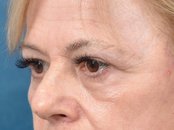 Eyelid Lift Gallery - Patient 141137956 - Image 4