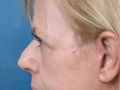 Eyelid Lift Before & After Gallery - Patient 141137956 - Image 6