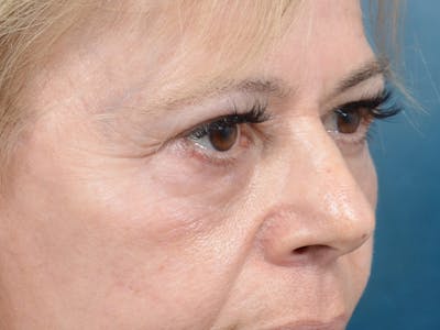 Eyelid Lift Before & After Gallery - Patient 141137956 - Image 10