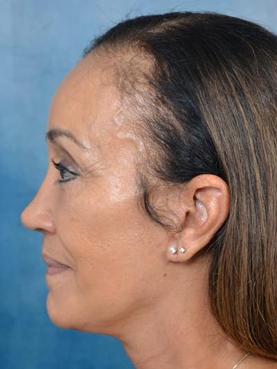 Brow Lift Before & After Gallery - Patient 141138264 - Image 6