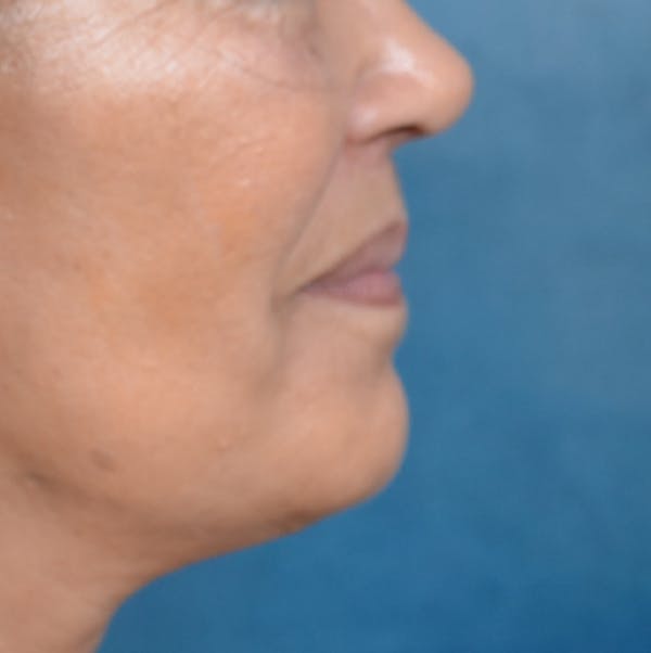 Lip Lift Before & After Gallery - Patient 141138003 - Image 10
