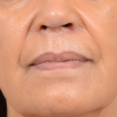 Lip Lift Before & After Gallery - Patient 141138003 - Image 1