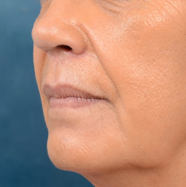 Lip Lift Before & After Gallery - Patient 141138003 - Image 3
