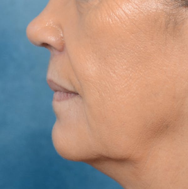 Lip Lift Before & After Gallery - Patient 141138003 - Image 5