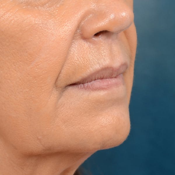 Lip Lift Before & After Gallery - Patient 141138003 - Image 7