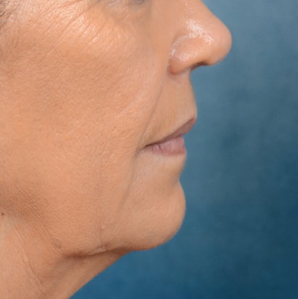 Lip Lift Before & After Gallery - Patient 141138003 - Image 9