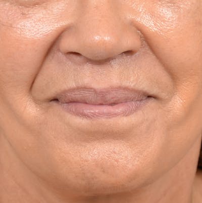 Lip Lift Before & After Gallery - Patient 141138003 - Image 2