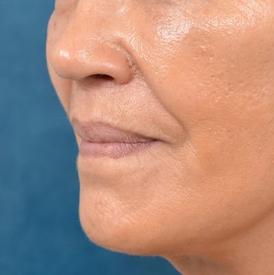 Lip Lift Before & After Gallery - Patient 141138003 - Image 4