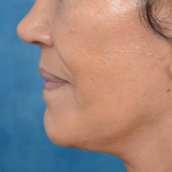 Lip Lift Before & After Gallery - Patient 141138003 - Image 6