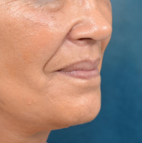 Lip Lift Before & After Gallery - Patient 141138003 - Image 8