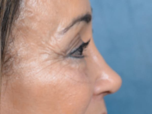 Eyelid Lift Before & After Gallery - Patient 141138007 - Image 8