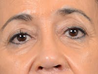 Eyelid Lift Before & After Gallery - Patient 141138007 - Image 1