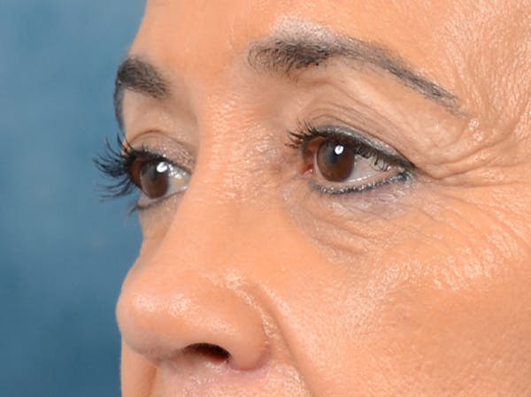 Eyelid Lift Before & After Gallery - Patient 141138007 - Image 3