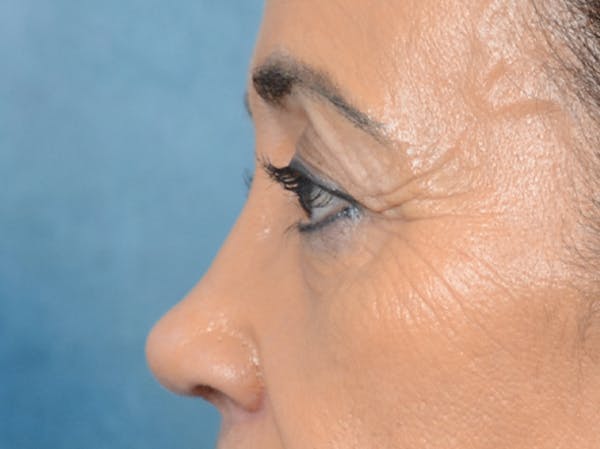 Eyelid Lift Gallery - Patient 141138007 - Image 5