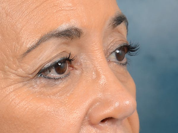 Eyelid Lift Before & After Gallery - Patient 141138007 - Image 9