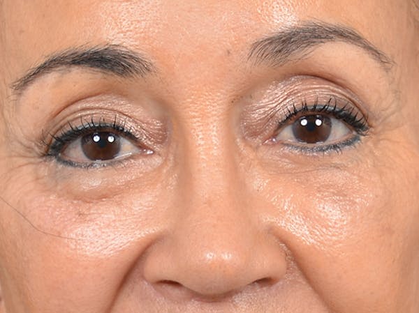 Eyelid Lift Gallery - Patient 141138007 - Image 2