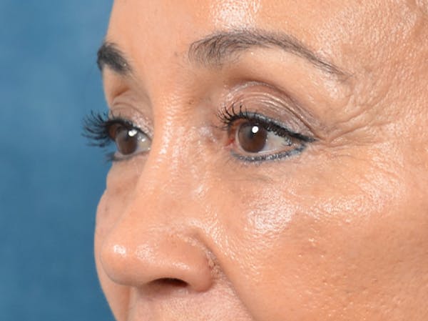 Eyelid Lift Gallery - Patient 141138007 - Image 4