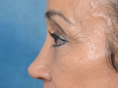 Eyelid Lift Before & After Gallery - Patient 141138007 - Image 6