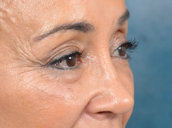Eyelid Lift Before & After Gallery - Patient 141138007 - Image 10