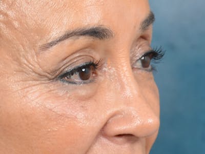 Eyelid Lift Before & After Gallery - Patient 141138007 - Image 10