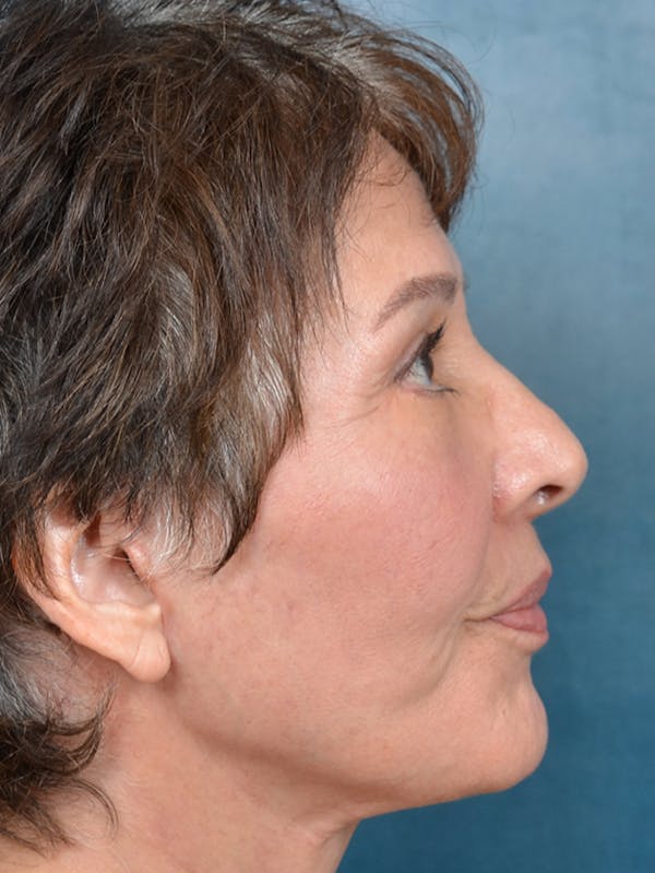 Deep Plane Facelift Before & After Gallery - Patient 141138419 - Image 10