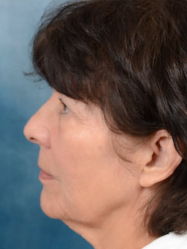 Deep Plane Facelift Before & After Gallery - Patient 141138419 - Image 5