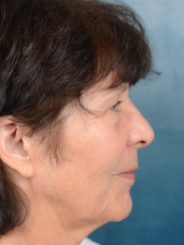 Laser Skin Resurfacing Before & After Gallery - Patient 141138479 - Image 9