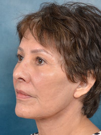 Brow Lift Before & After Gallery - Patient 141138488 - Image 4