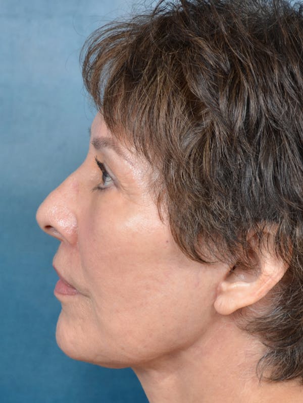 Brow Lift Before & After Gallery - Patient 141138488 - Image 6