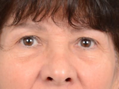 Eyelid Lift Before & After Gallery - Patient 141138438 - Image 1