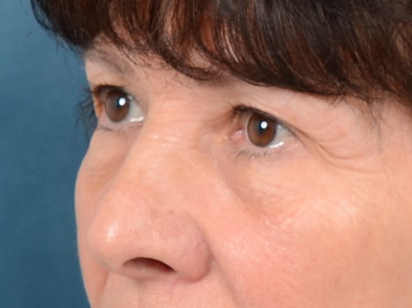Eyelid Lift Before & After Gallery - Patient 141138438 - Image 3