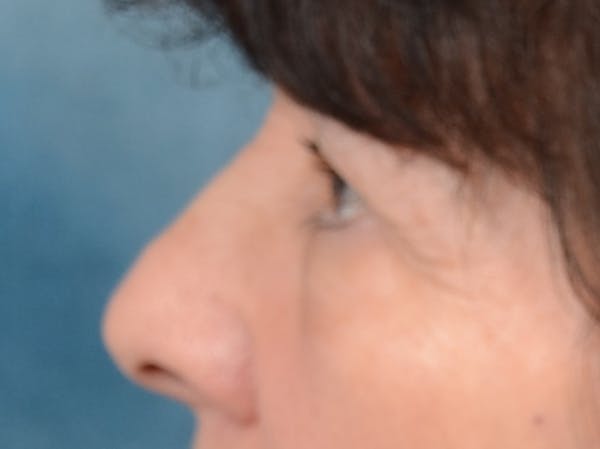 Eyelid Lift Before & After Gallery - Patient 141138438 - Image 5