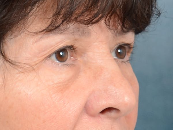 Eyelid Lift Before & After Gallery - Patient 141138438 - Image 9