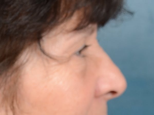 Eyelid Lift Before & After Gallery - Patient 141138438 - Image 7