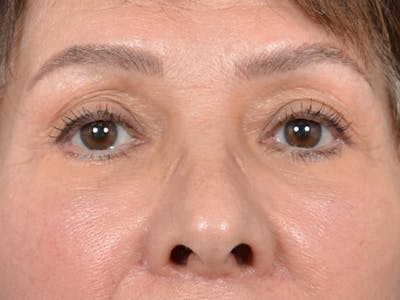 Eyelid Lift Before & After Gallery - Patient 141138438 - Image 2